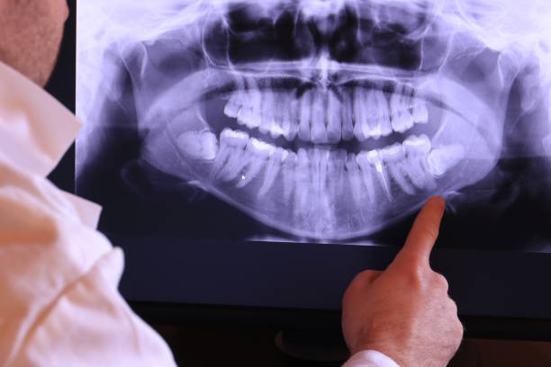 Best Knocked-Out Tooth (Avulsed Tooth) Treatment in Corry, PA